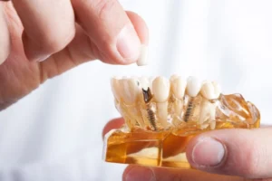 Are Patients Sedated For Dental Implant Treatments