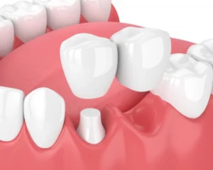 How Often Should I Get My Dental Bridges Replaced