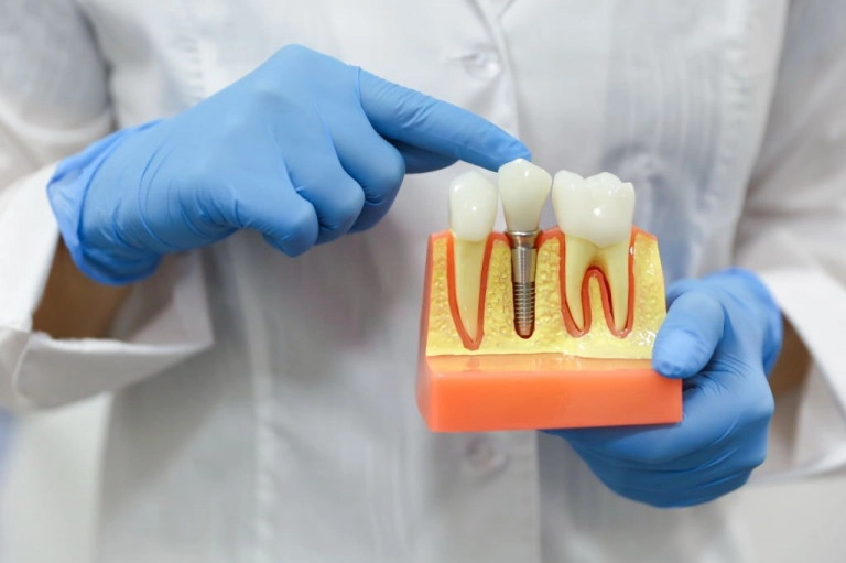 dental implant blog