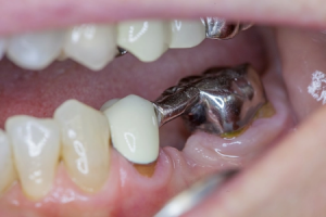 dental-bridege inner