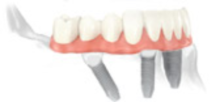 nonremoveable teeth solution1