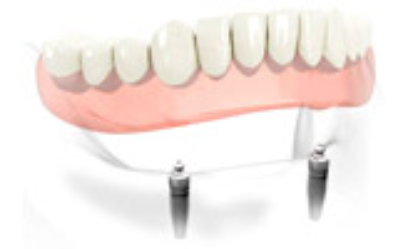 nonremoveable teeth solution2