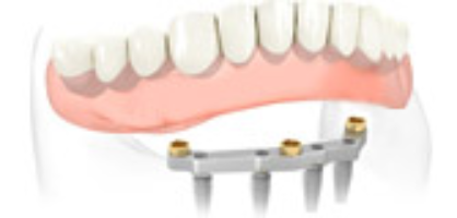 nonremoveable teeth solution3