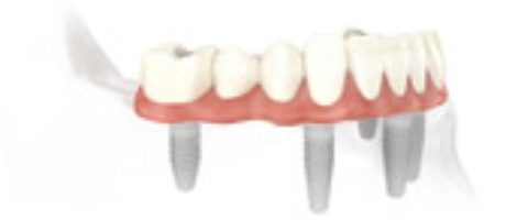 nonremoveable teeth solution4