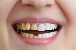 Get The Perfect Smile With Cosmetic Dentistry In Irving, TX_FI