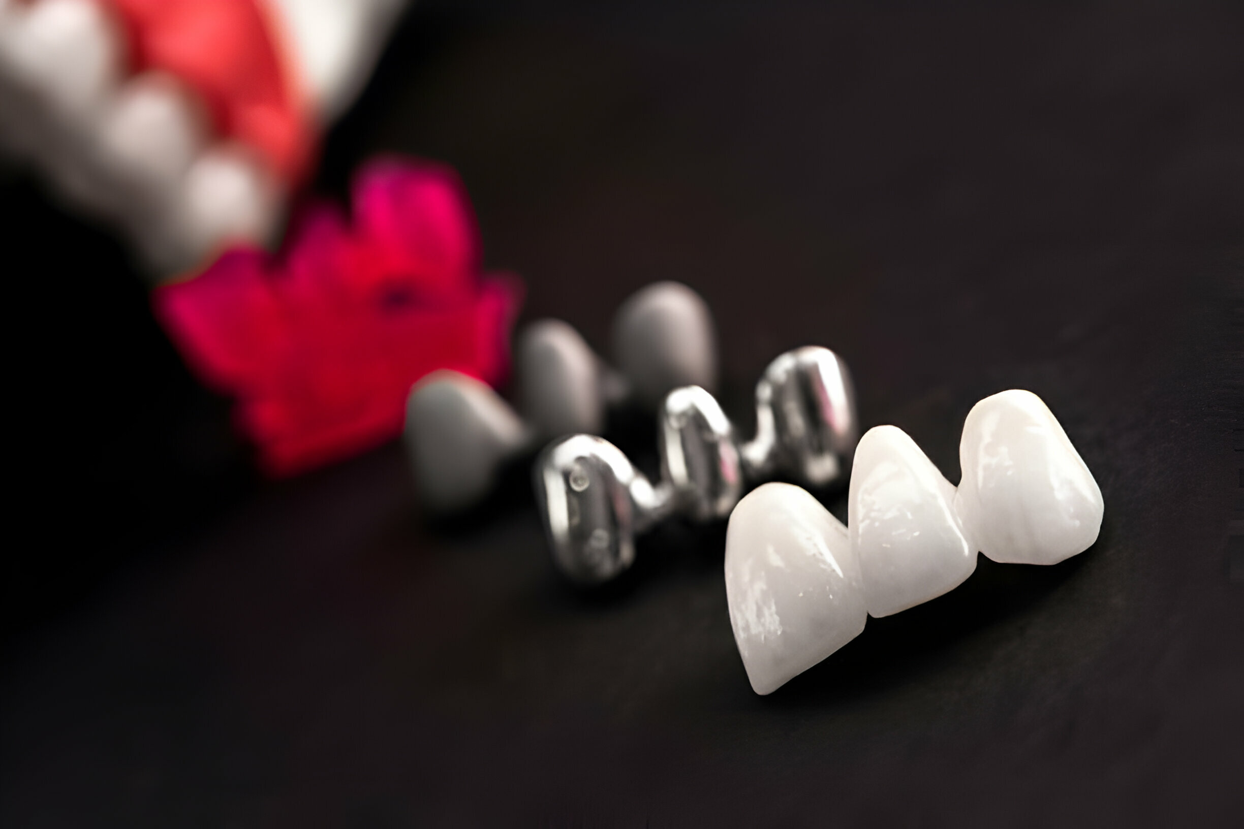 Preparing for Your Dental Crown Procedure: What to Expect?_FI