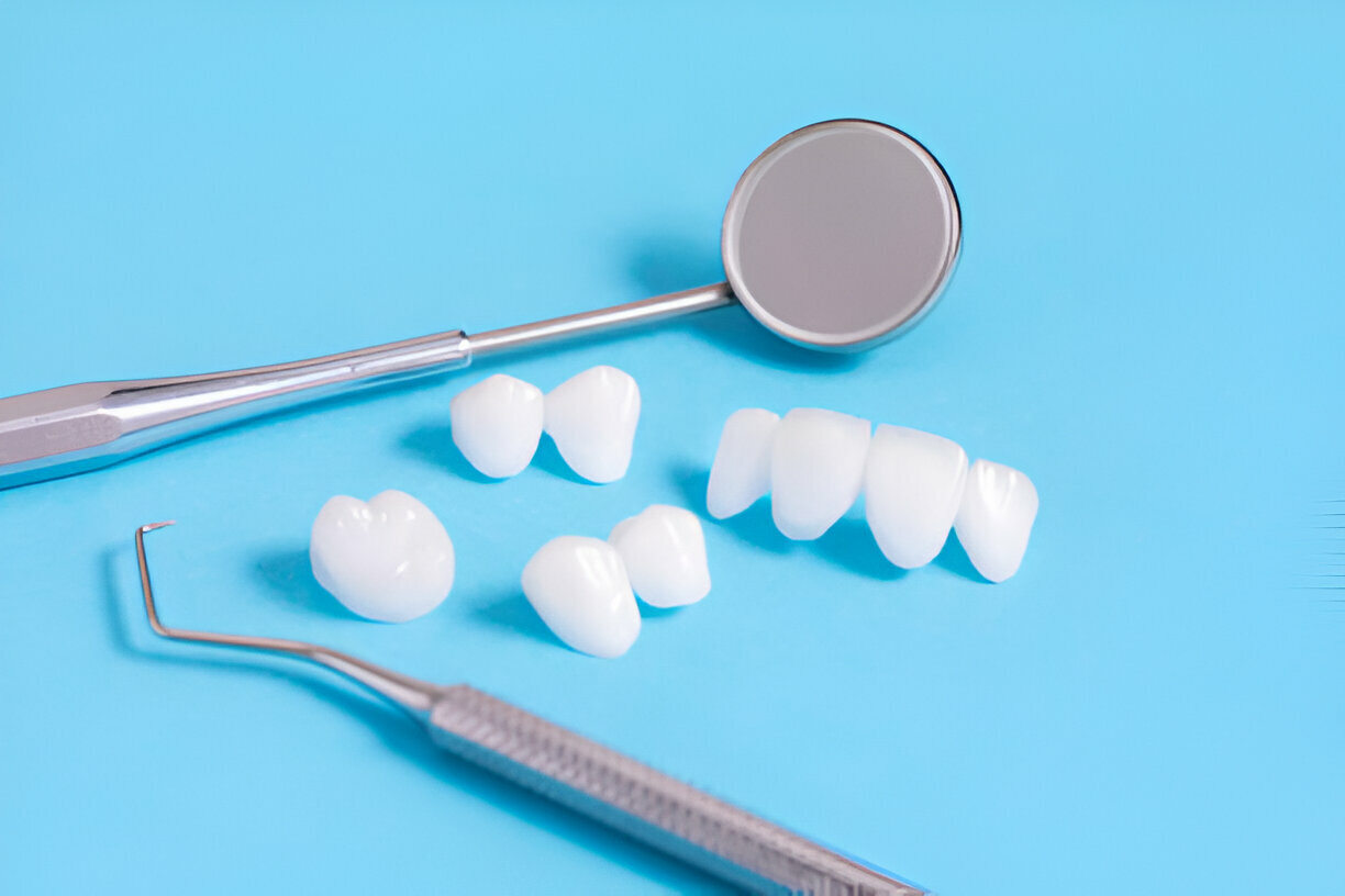 Porcelain Veneers in Irving, TX: What You Can Expect at Gentle Dentistry of Las Colinas_2