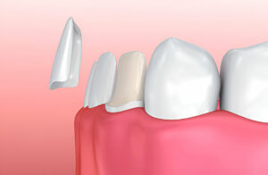 Porcelain Veneers in Irving, TX: What You Can Expect at Gentle Dentistry of Las Colinas_FI