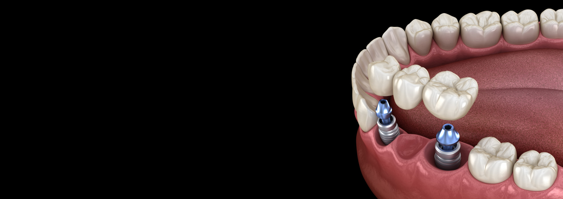 Dental Bridges Banner Image
