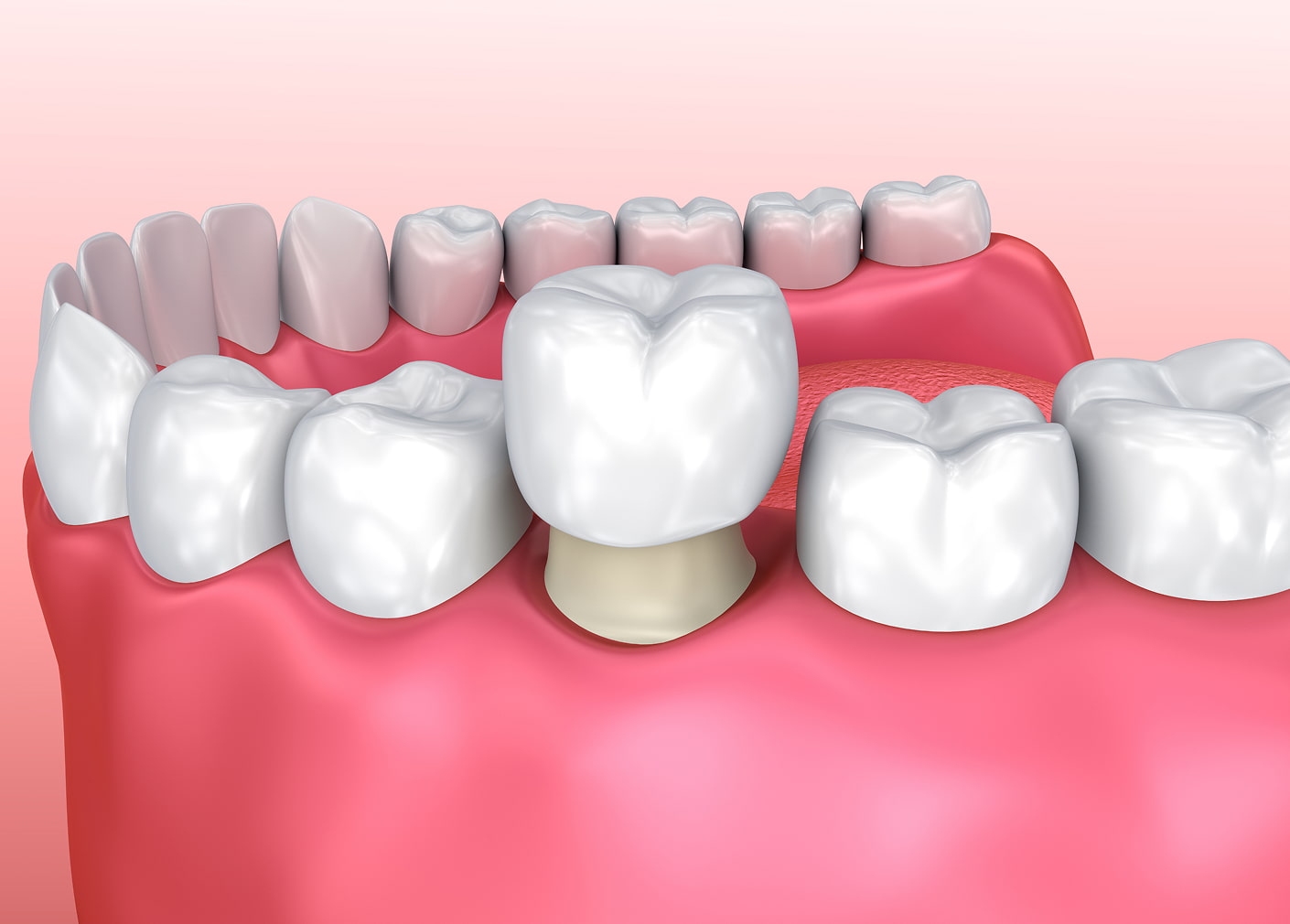 Dental crowns restore strength and appearance to damaged teeth