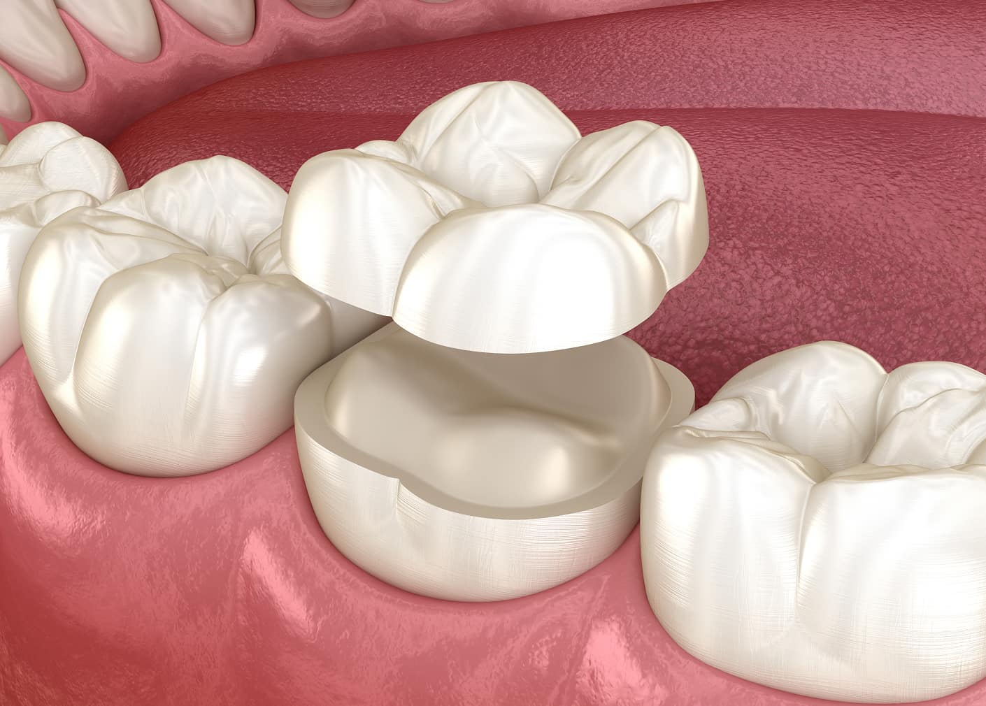 Durable tooth restoration for damaged teeth
