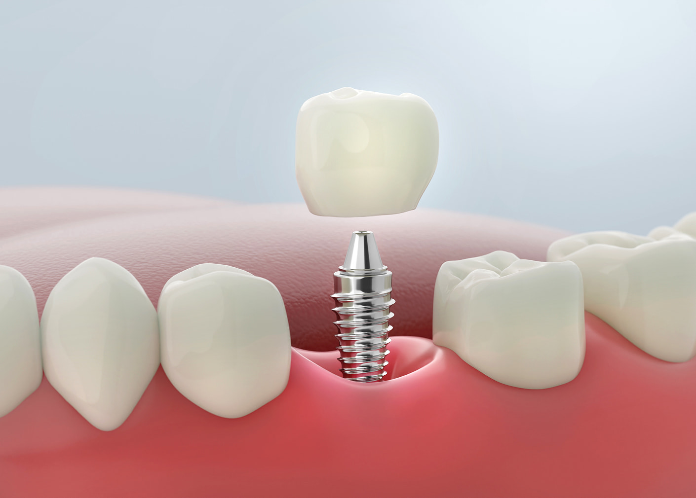 Removable dentures for complete or partial tooth replacement
