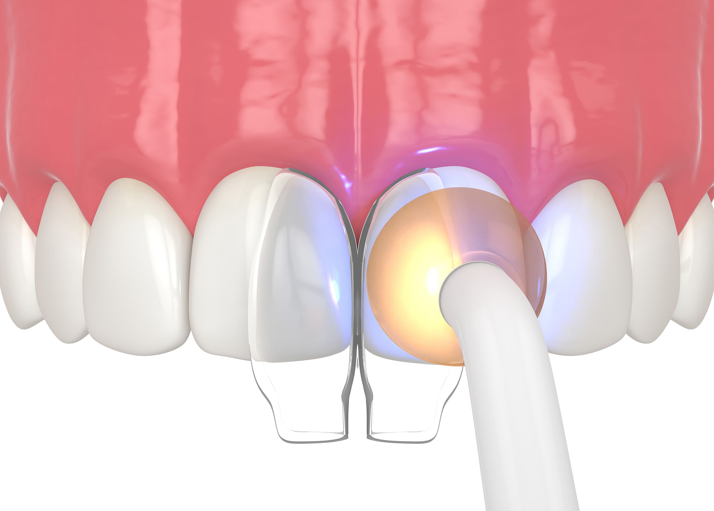 Dental Bonding