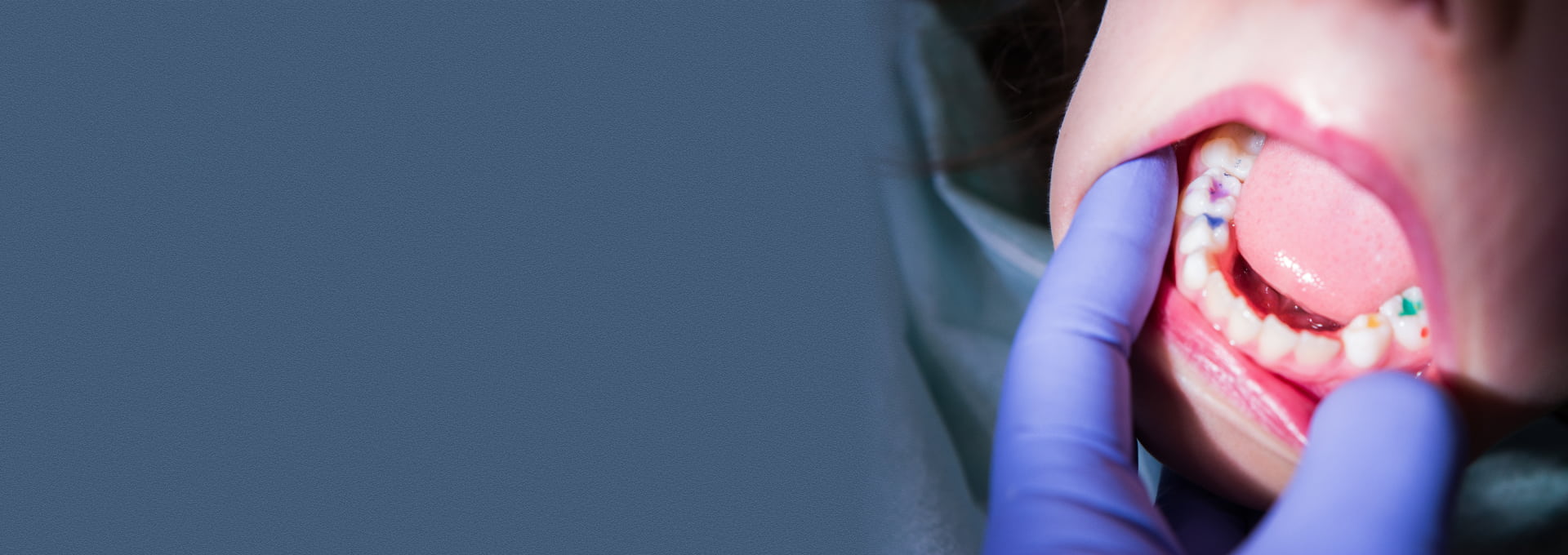 Tooth-Colored Fillings Banner Image