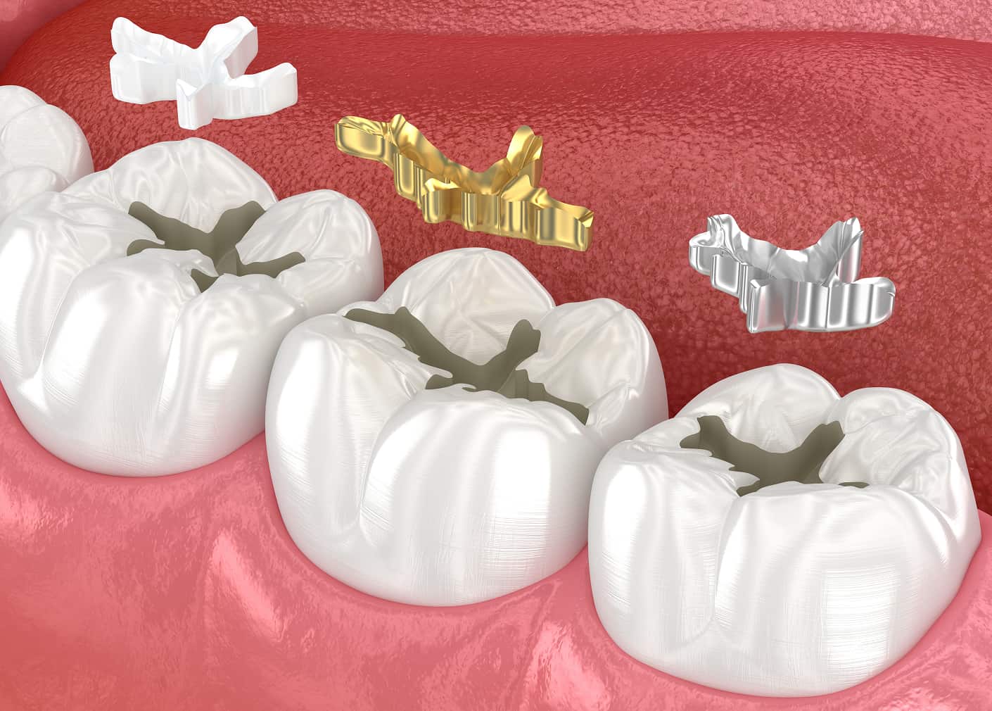 Tooth-colored fillings for a natural, aesthetic smile