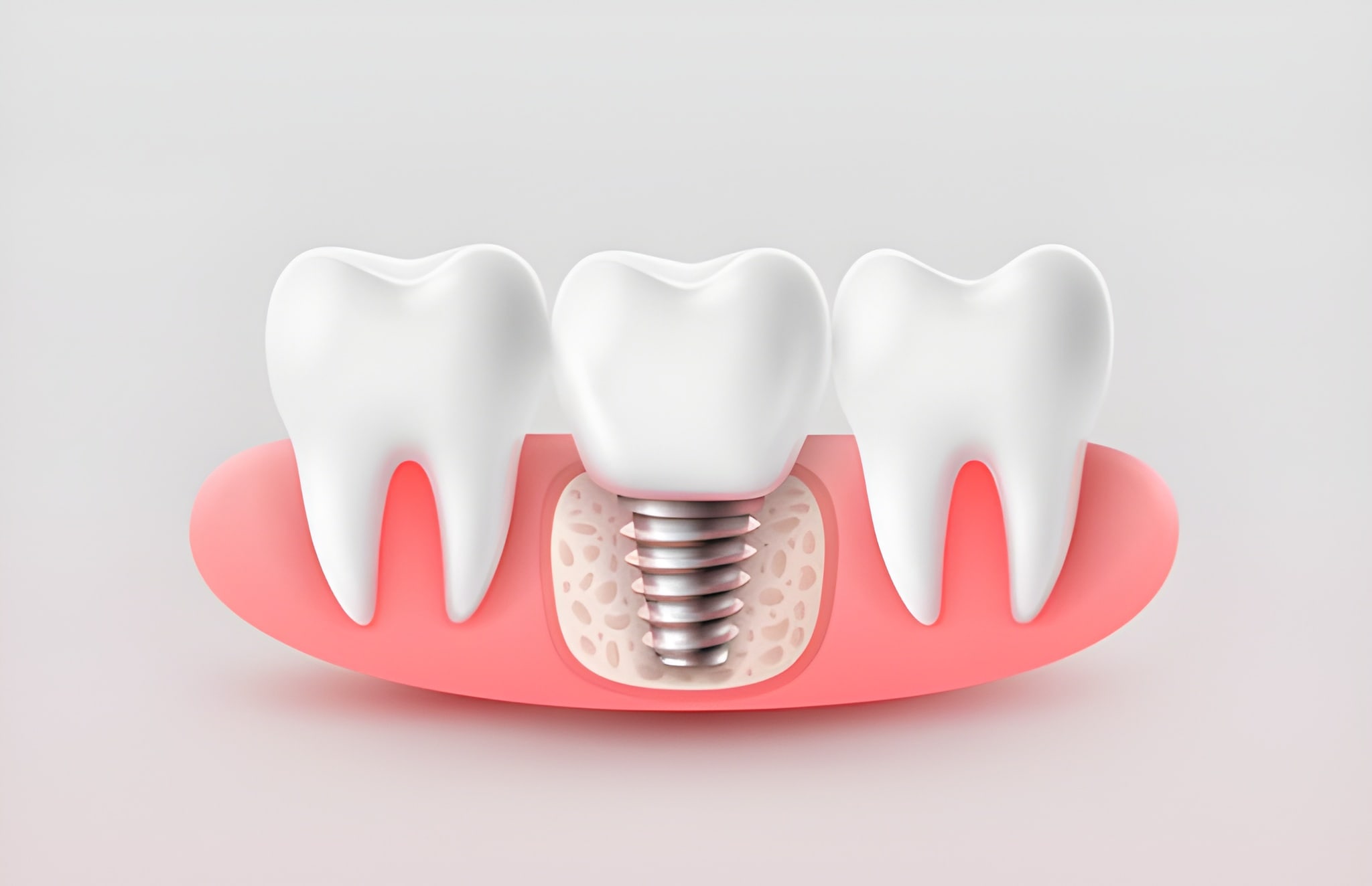 Why Irving, TX Residents Trust Gentle Dentistry of Las Colinas for Dental Implants_FI
