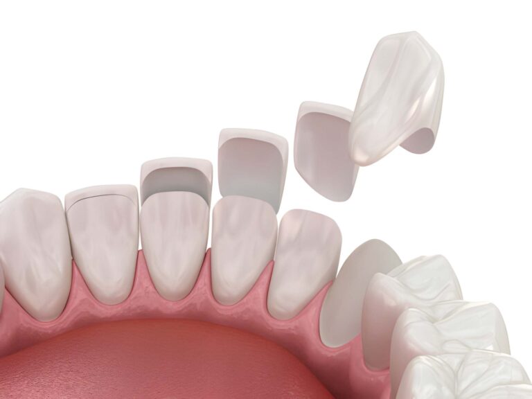 Why Irving Patients Choose Gentle Dentistry of Las Colinas for Porcelain Veneers_FI
