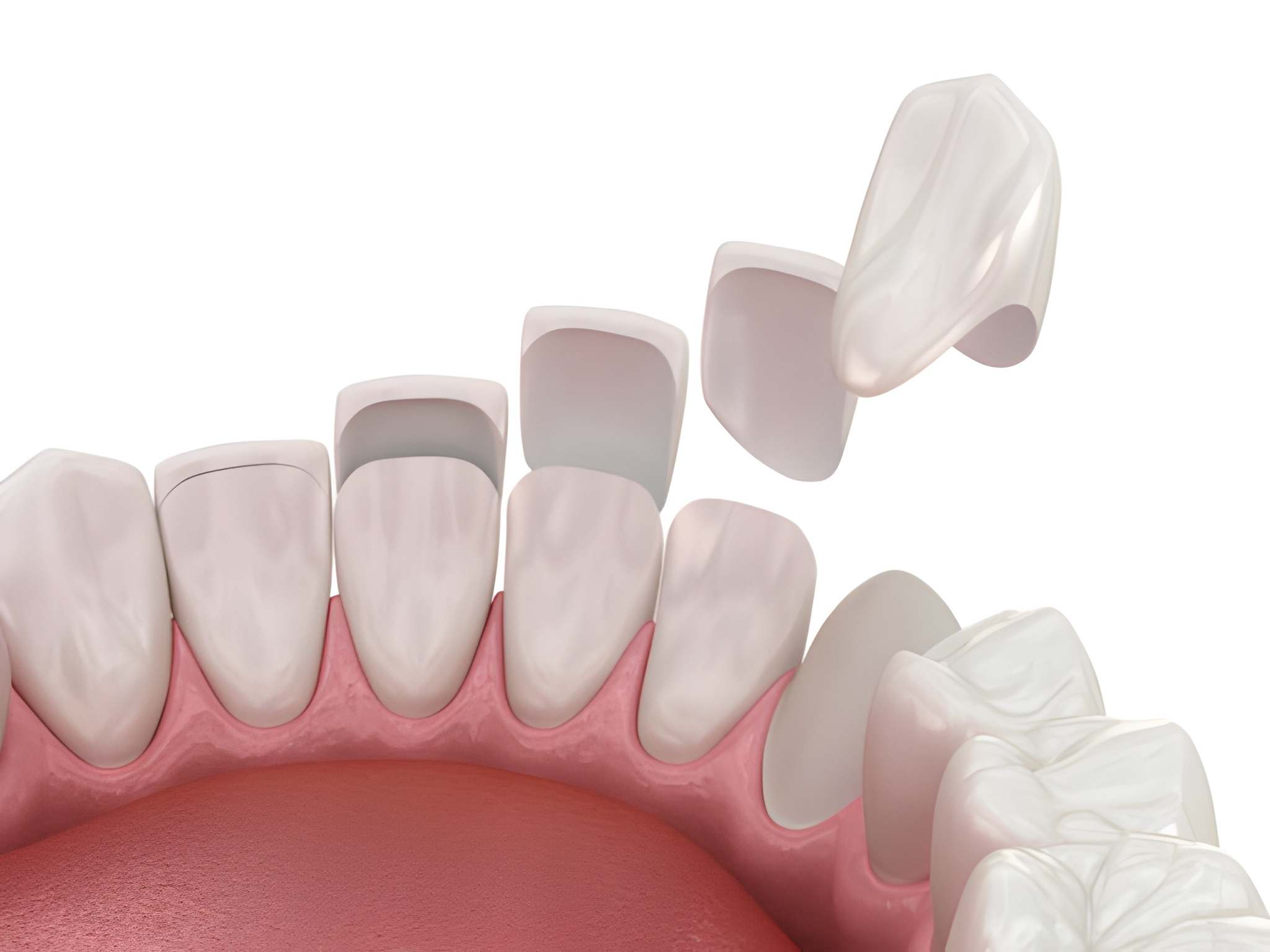 Why Irving Patients Choose Gentle Dentistry of Las Colinas for Porcelain Veneers_FI